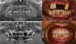 佛山种牙爆料事件最新情况,最新进展与各方回应梳理